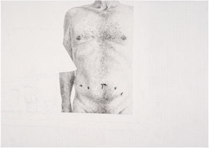 Artistic hand drawing by Herbert Stattler of a patient’s reflection in a hospital room mirror. The image shows a bare male torso nine weeks post-prostatectomy with visible healing scars, framed by the partial view of a bedside reading lamp.